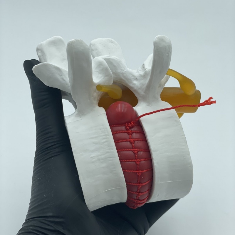 Грыжа межпозвоночная муляж